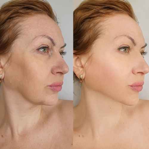 HIFU Non Surgical Facelift Aldershot