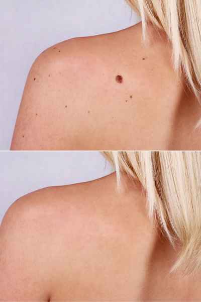 Why Does a Benign Mole Aldershot Occur?
