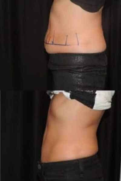 HIEMT Muscle Toning Aldershot