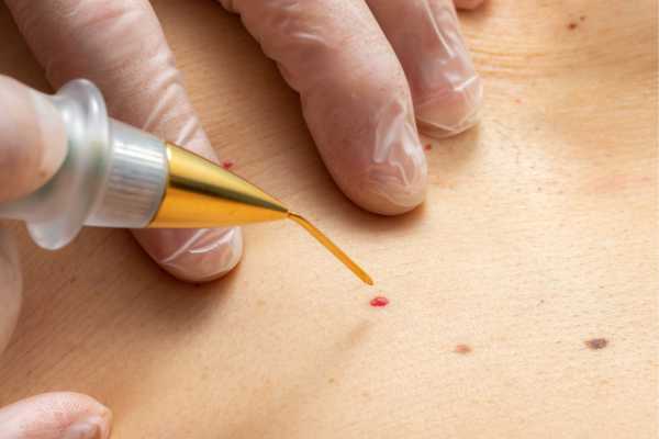 Dermatofibroma Removal Aldershot - How We Remove It