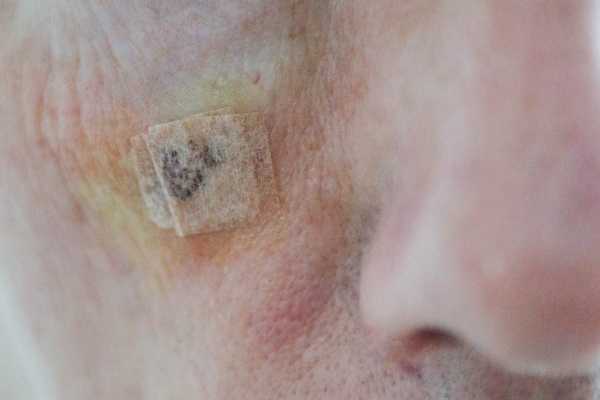 seborrheic keratoses removal Aldershot