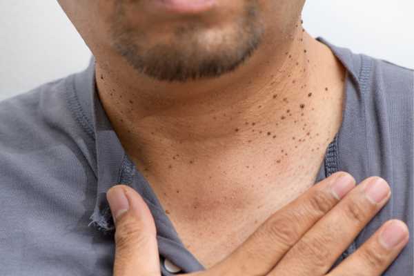How Does Skin Tag Removal Aldershot Work?
