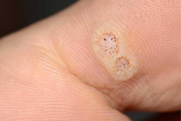 wart removal Aldershot