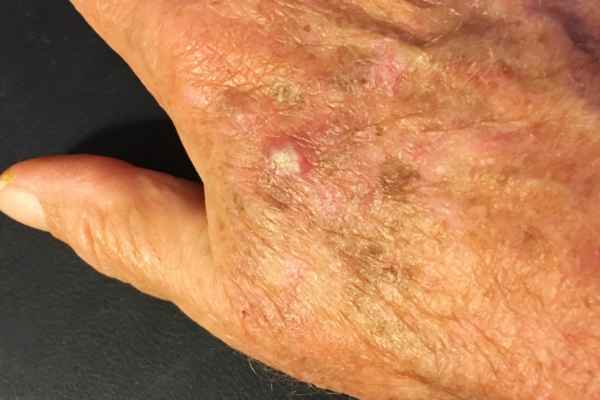What Makes CryoPen a Safe Choice for Wart Removal Aldershot?
