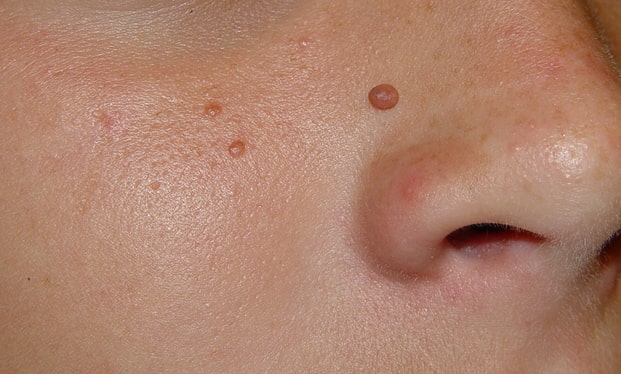 Angiofibromas Aldershot Removal Treatment