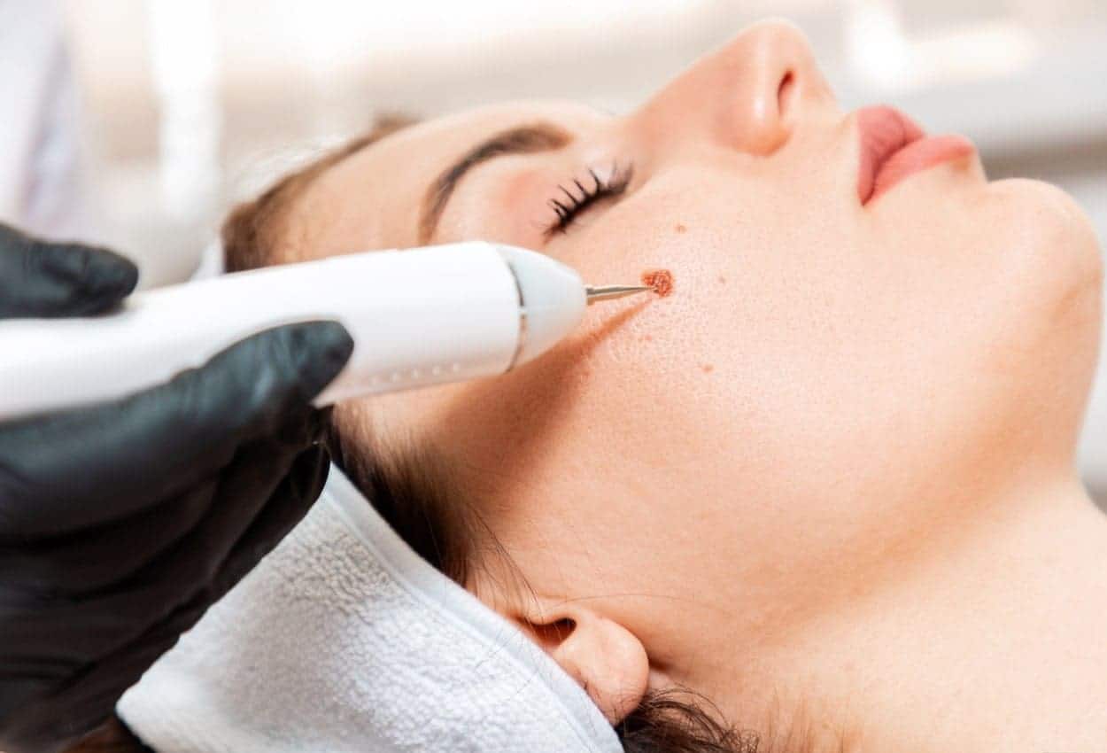 Benefits of Ephelides Treatment Aldershot