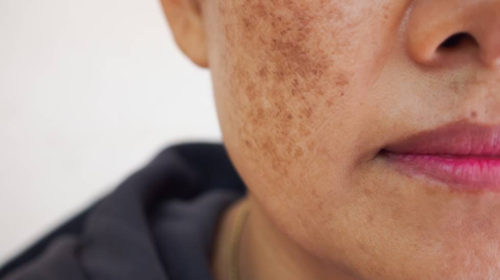 Ephelides Treatment Aldershot