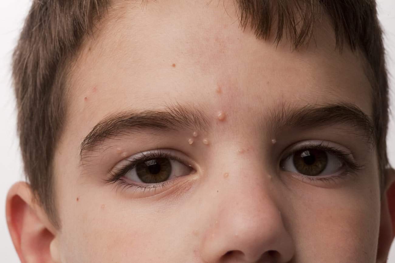 Molluscum Contagiosum Aldershot, How We Remove It