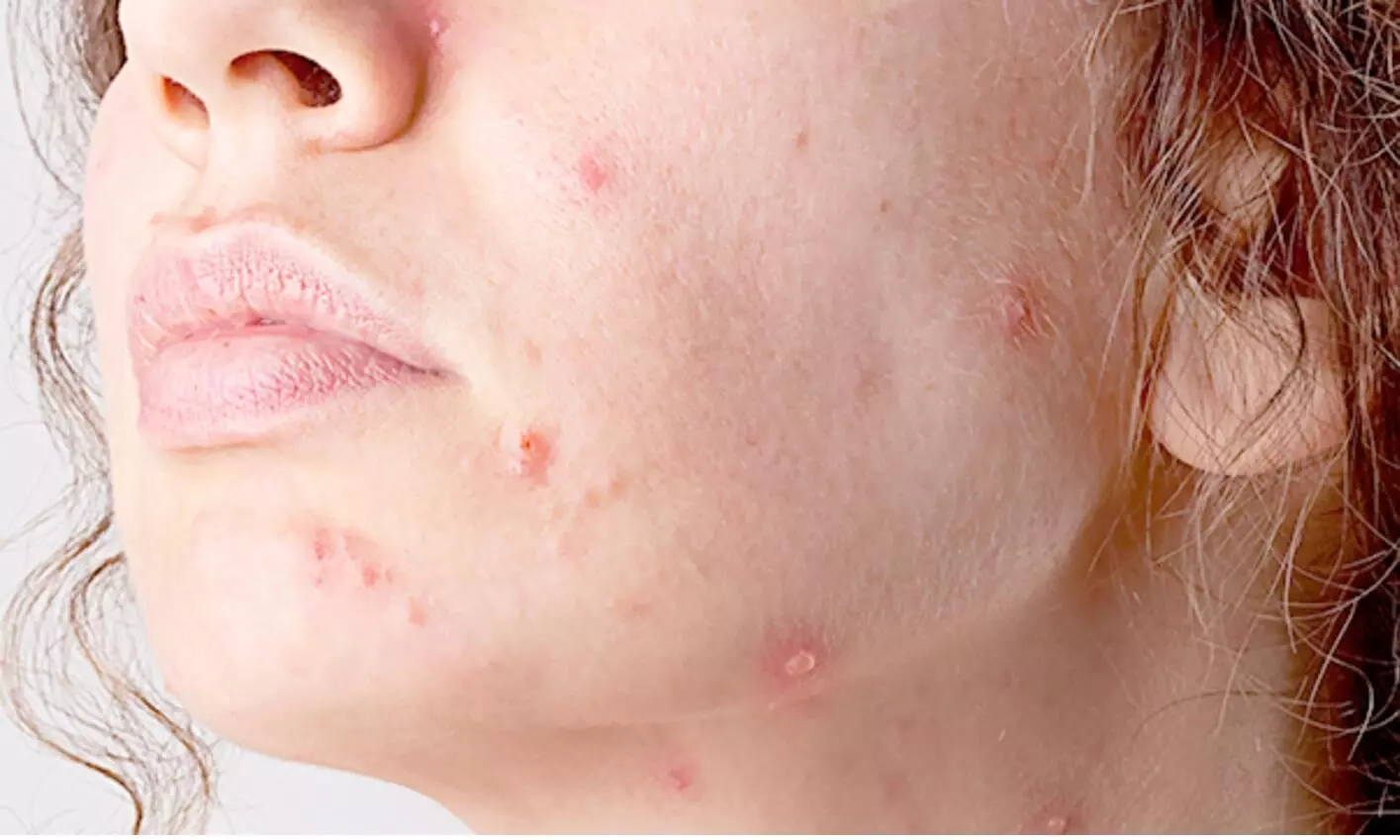 Porokeratosis Aldershot, How We Remove It