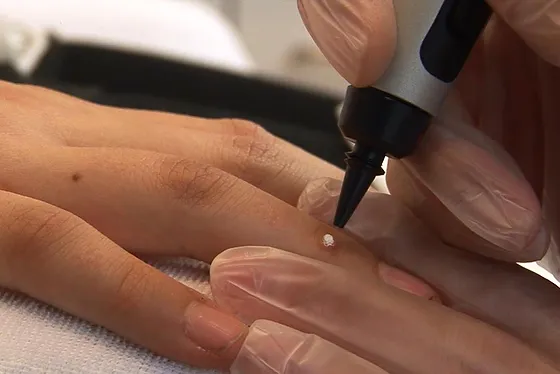 Porokeratosis Treatment Aldershot