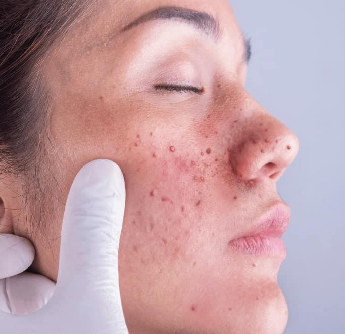 Angiofibroma Treatment Aldershot