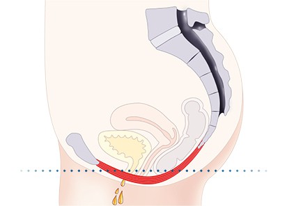 Pelvic floor muscles Aldershot
