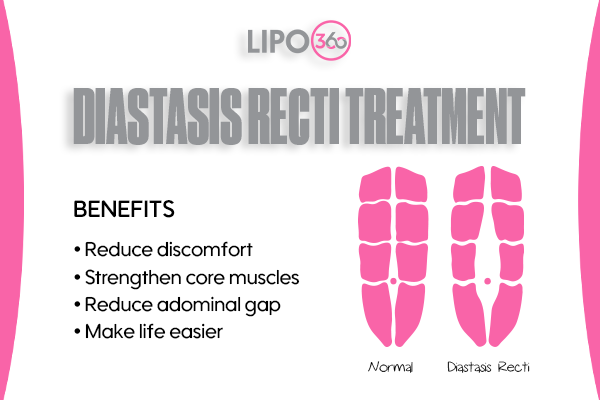 diastasis recti treatment Aldershot
