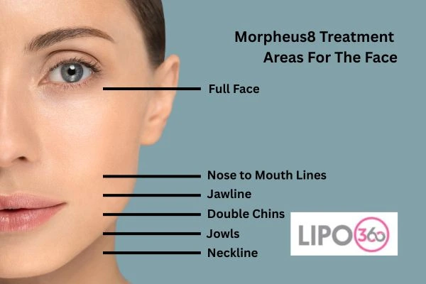 Morpheus8 Aldershot Anti ageing treatment! Book in today!