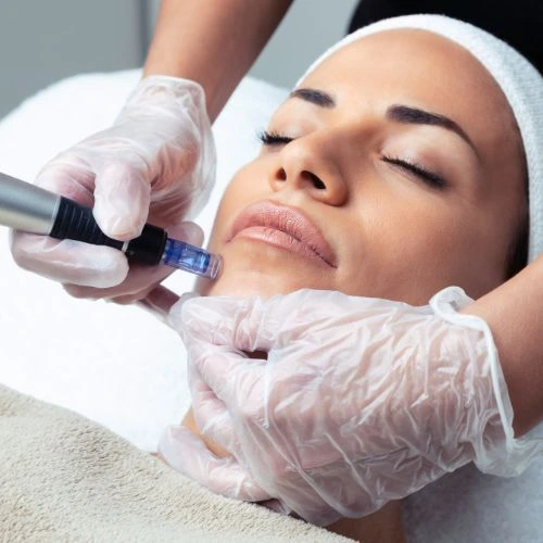 Targeted wrinkle and fine line treatment with Morpheus8 Aldershot Book in NOW!