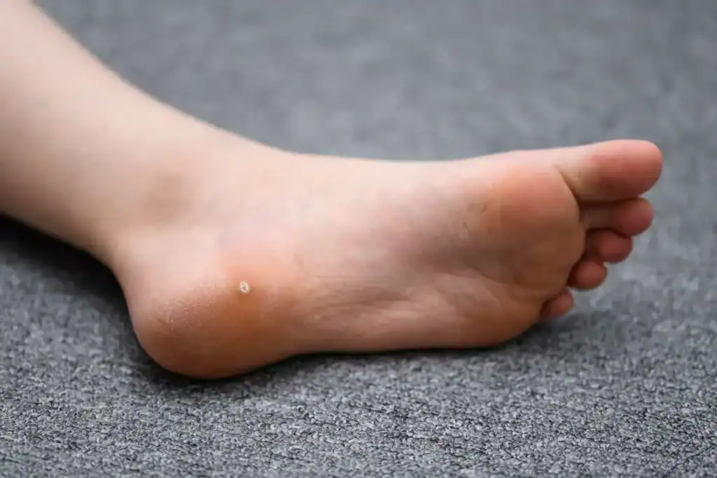 Image of verruca on the bottom of the foot that able to be treated with Cryotherapy Aldershot
