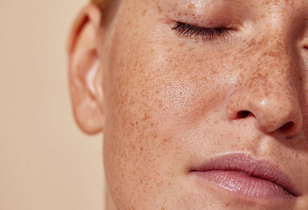 Why Is Lipo 360 Aldershot the Right Place for Ephelides Treatment?