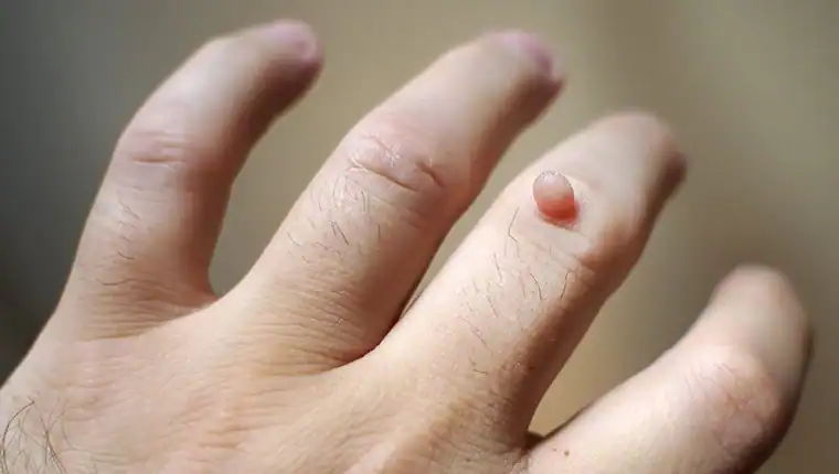 Image of blemish that Cryotherapy Aldershot can remove with Lipo 360.