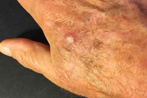 Image of Actinic keratoses Aldershot on a person hand