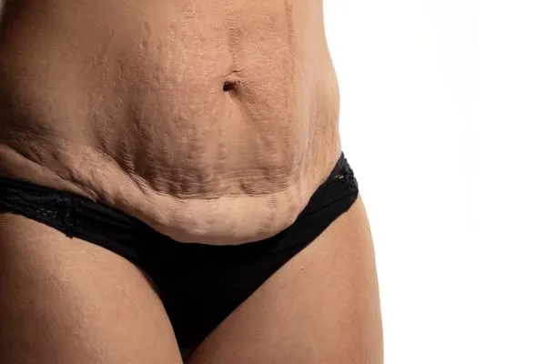 The science behind skin tightening Aldershot picture of a woman's sagging skin on the stomach