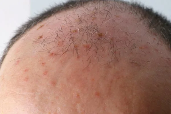 Actinic Keratoses Aldershot