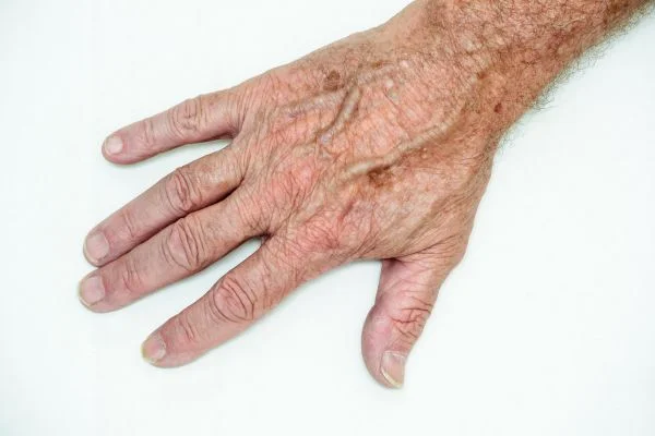 age spot removal Aldershot
