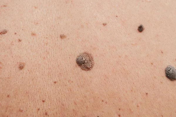 Benign Moles Aldershot