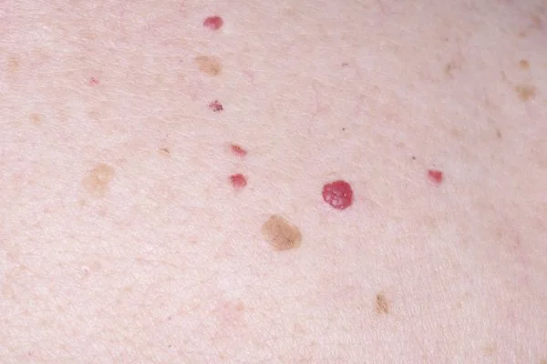 Cherry Angiomas Aldershot