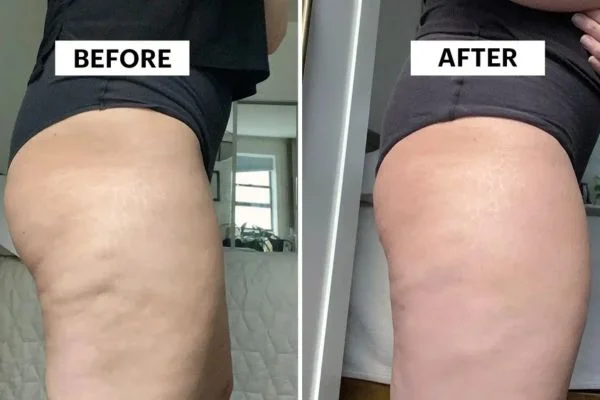 Body Sculpting Results Aldershot