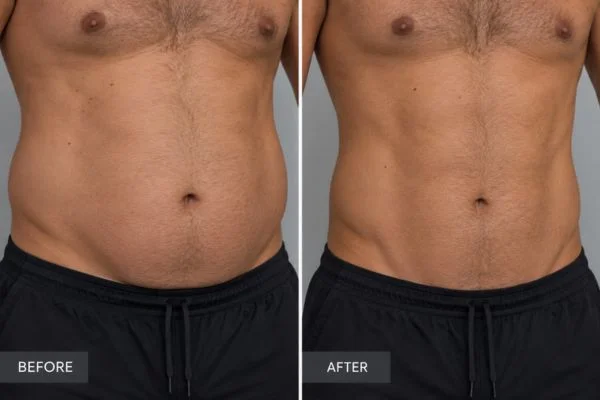 Body sculpting results Aldershot