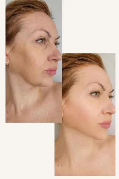 HIFU Results Aldershot before and after