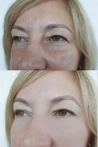 collagen lift 360 results Aldershot