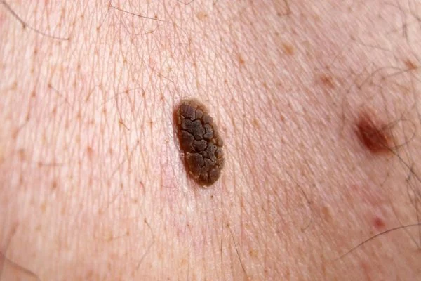 Seborrhoeic Keratoses removal Aldershot