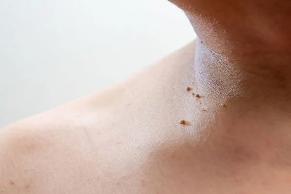 skin tag removal Aldershot